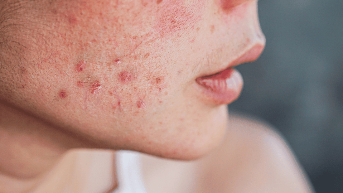 The Ultimate Guide to Acne Skincare: Causes, Treatments, and Clean Solutions