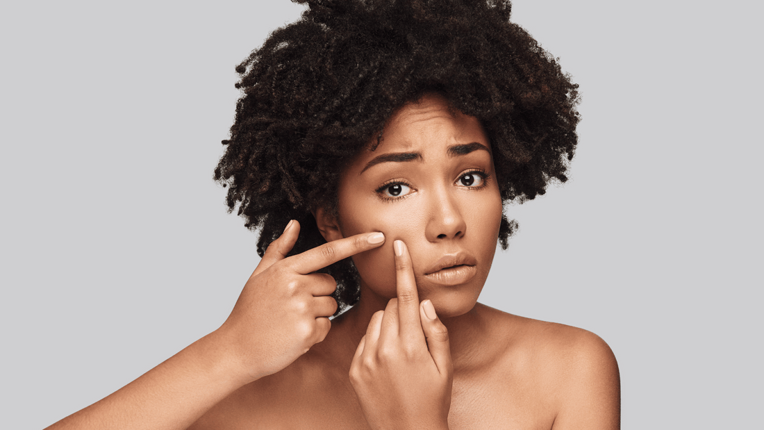 How to Fade Acne Scars Without Harsh Treatments