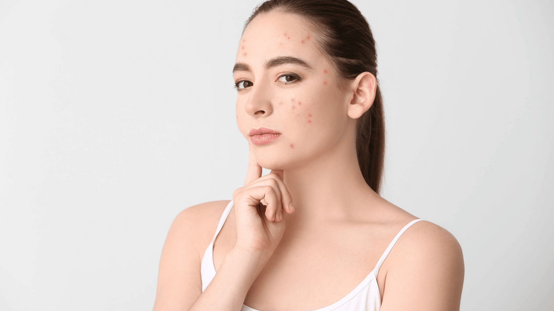 Fragrance-Free Skincare for Acne: Why It Matters More Than You Think
