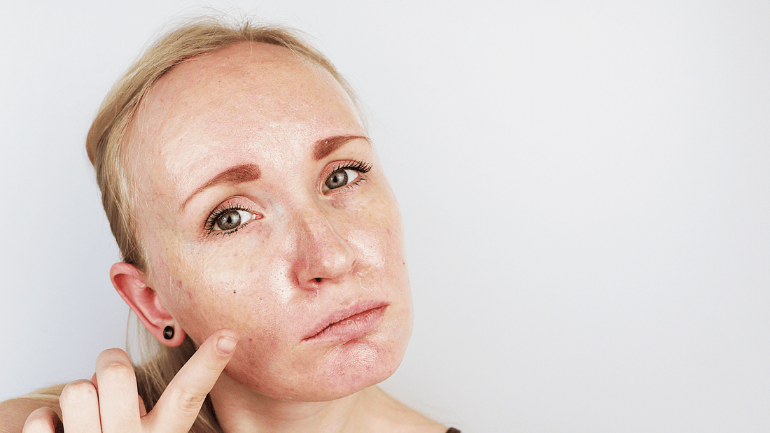 The Truth About Acne Scarring: Types, Causes & How to Treat Them Effectively