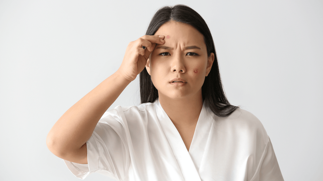 What Causes Acne? Breaking Down Hormones, Diet & Skincare Triggers