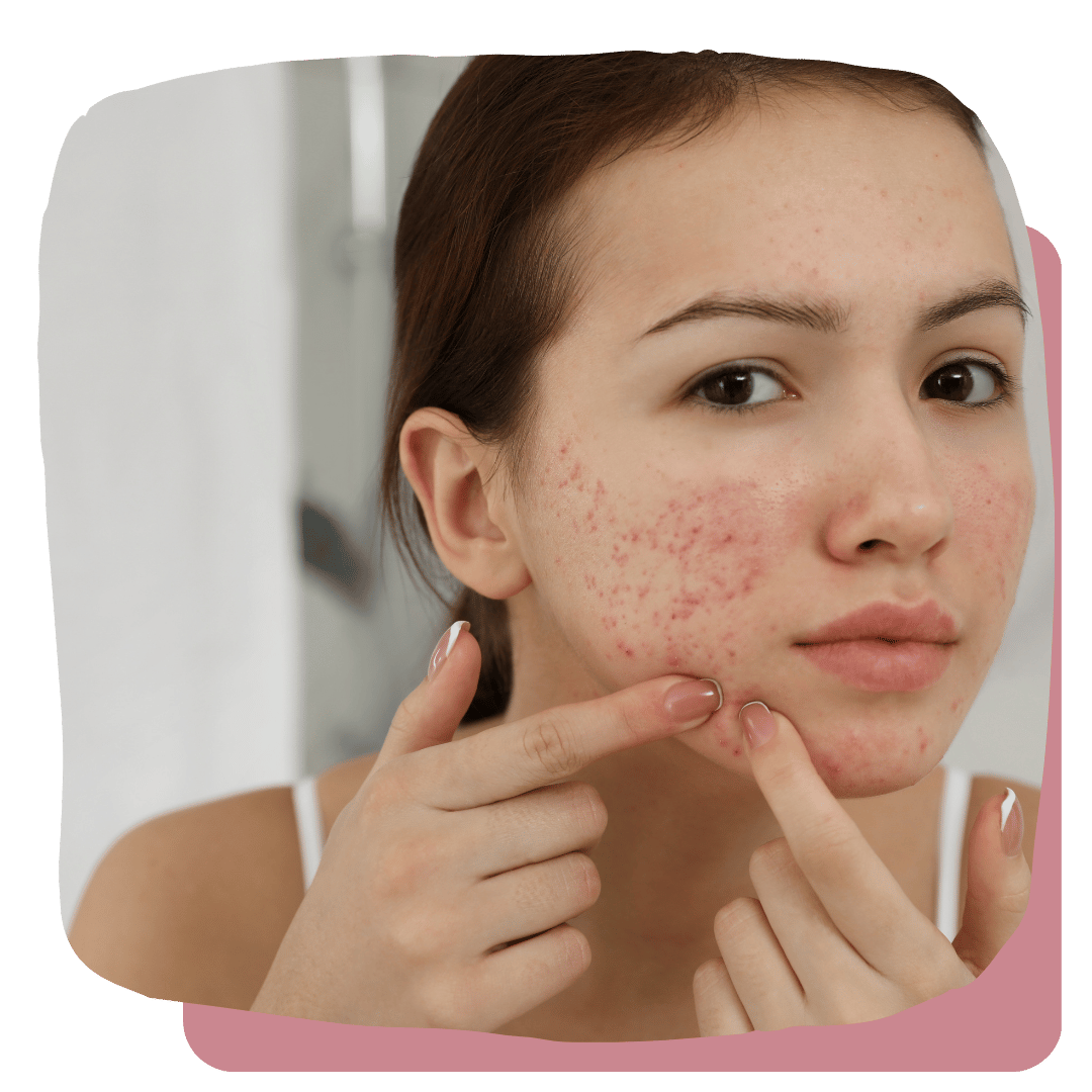 Acne & Imperfections - Clear Skin Starts Here